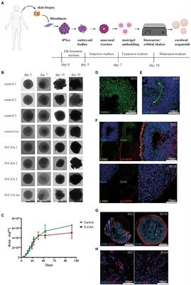 Amyloid beta accumulations and enhanced neuronal differentiation in cerebral organoids of Dutch-type cerebral amyloid angiopathy patients